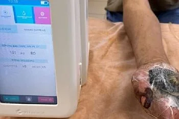 В хирургическом отделении № 4 Центральной городской клинической больницы активно используются передовые технологии для лечения ран В хирургическом отделении № 4 Центральной городской клинической больницы активно используются передовые технологии для лечения ран